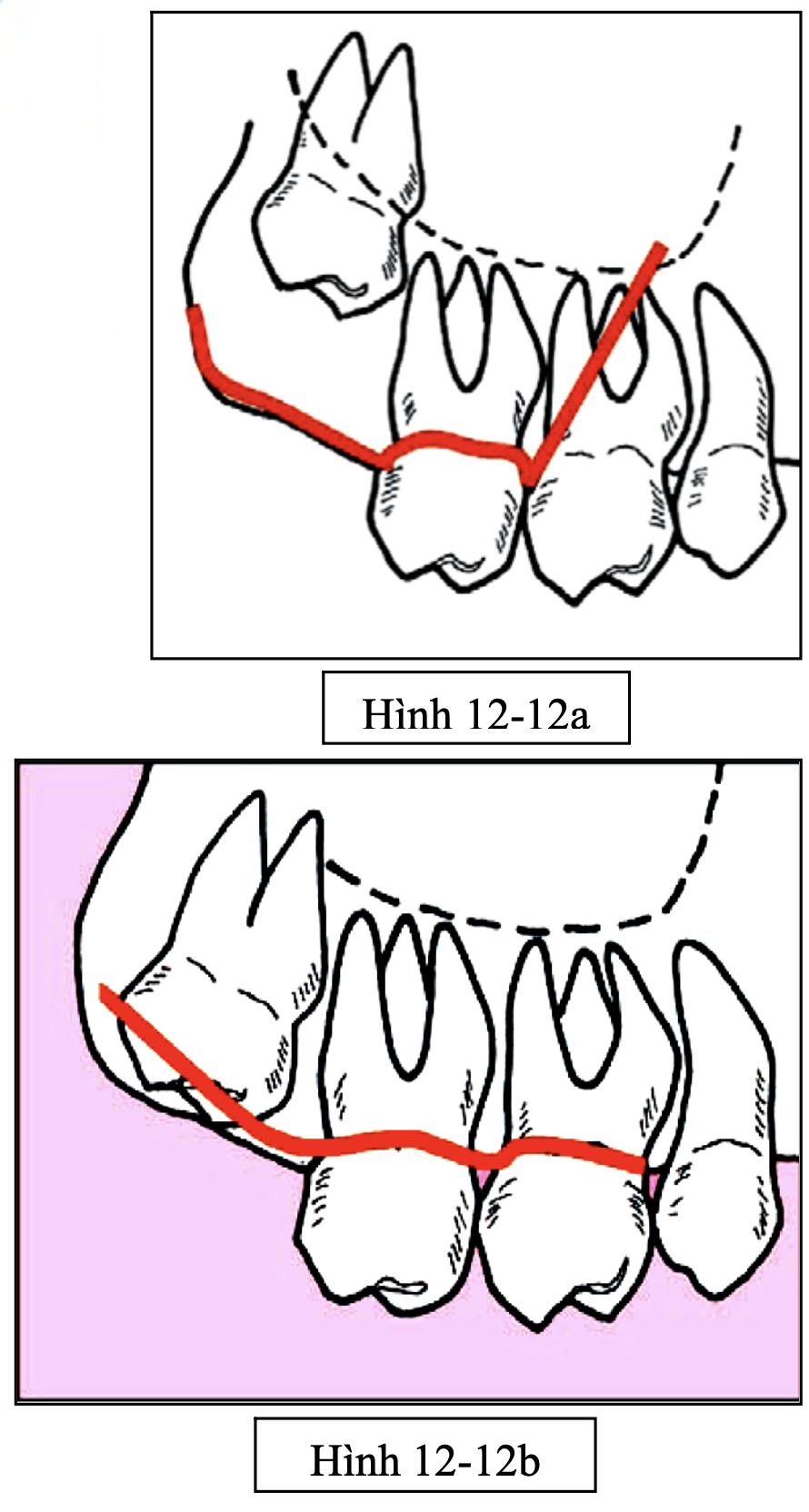 Tiểu phẫu răng khôn hàm trên